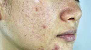Pemberian Isotretinoin untuk Terapi Acne Vulgaris