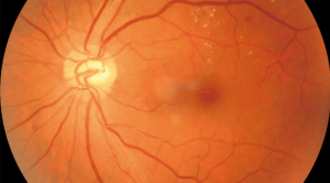 Injeksi Anti-VEGF untuk Terapi Retinopati Diabetik