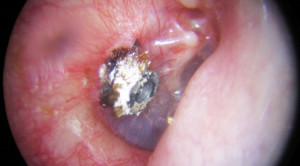 Peranan Pipa Ventilasi Telinga pada Otitis Media dengan Efusi