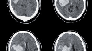 Andexanet untuk Perdarahan Intraserebral Akut Terkait Inhibitor Faktor Xa – Telaah Jurnal Alomedika