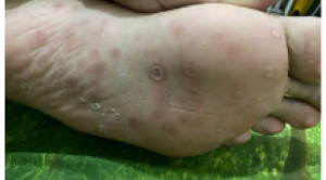 Lesi Makulopapular pada Sifilis Sekunder