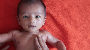 Kekurangan Nutrisi Meningkatkan Risiko Tuberkulosis Dua Kali Lipat