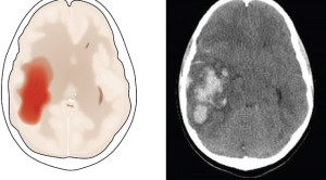 Perdarahan Intraserebral Akut – Efikasi dan Keamanan Penurunan Tekanan Darah Intensif