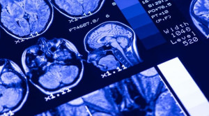 Uji Noninvasif untuk Prediksi Dementia – Telaah Jurnal Alomedika