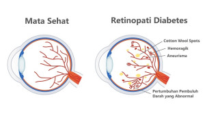 Efikasi Fenofibrate pada Retinopati Diabetes