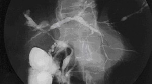 Apakah Kolangiografi Intraoperatif Rutin Diperlukan pada Laparoskopi Kolesistektomi Kasus Kolelitiasis – Telaah Jurnal Alomedika