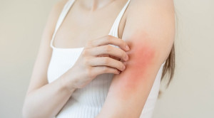 Pedoman Penanganan Dermatitis Atopik 2024 – Ulasan Guideline Terkini