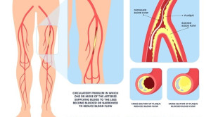 Pedoman Penanganan Penyakit Arteri Perifer pada Ekstremitas Bawah 2024 – Ulasan Guideline Terkini