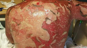 Antibiotik Terkait Sindrom Stevens Johnson dan Toxic Epidermal Necrolysis