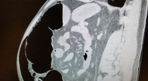 Ileus Pasca Sectio Caesarea terkait Sindrom Ogilvie