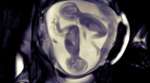 Pedoman Manajemen Kehamilan Kembar dan Triplet 2024 – Ulasan Guideline Terkini