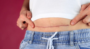 Skar Sectio Caesarea Berisiko Tinggi Menyebabkan Plasenta Akreta