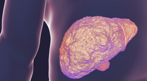 Pedoman Penanganan Karsinoma Hepatoseluler 2024 – Ulasan Guideline Terkini