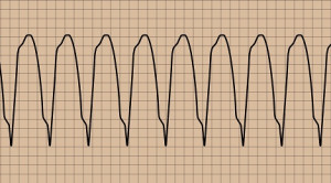 Meneropong Ablasi Kateter sebagai Terapi Lini Pertama Takikardia Ventrikel – Telaah Jurnal Alomedika