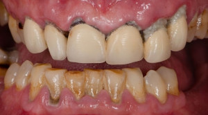 Hubungan Dua Arah Antara Penyakit Periodontal dan Diabetes