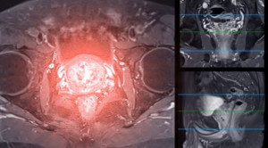 Adakah Tempat bagi Penggunaan MRI untuk Skrining Kanker Prostat – Telaah Jurnal Alomedika