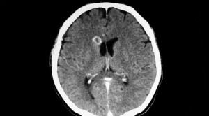 Diagnosis Banding pada Lesi Serebral dengan Penyangatan Cincin