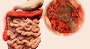 Carcinoembryonic Antigen dan Carbohydrate Antigen 19-9 untuk Skrining Kanker Gastrointestinal
