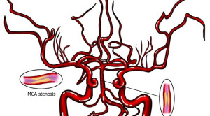 Perbandingan Ballon Angioplasty dengan Terapi Medikamentosa pada Stenosis Arteri Intrakranial – Telaah Jurnal Alomedika
