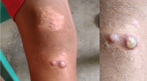 Pemberian Azithromycin Massal untuk Eliminasi Frambusia – Telaah Jurnal