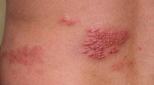 Efek Vaksinasi Herpes Zoster terhadap Kejadian Demensia – Telaah Jurnal Alomedika