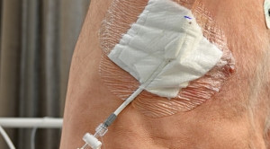 Torakosentesis Tidak Bermanfaat pada Kasus Gagal Jantung – Telaah Jurnal Alomedika