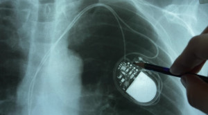 Pacu Jantung Biventrikular vs Ventrikular Kanan untuk AV Blok Simtomatik – Telaah Jurnal Alomedika