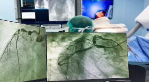 Percutaneous Coronary Intervention pada Sindrom Koroner Akut: Radial atau Femoral