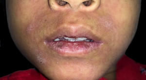 Manifestasi Xerostomia dan Sialolithiasis pada Pasien HIV dengan Terapi Antiretroviral