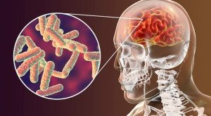 Pedoman Pemberian Kortikosteroid pada Meningitis – Ulasan Guideline Terkini