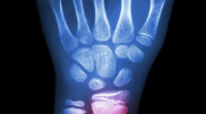 Pendekatan Non-Operatif pada Lansia dengan Fraktur Radius Distal