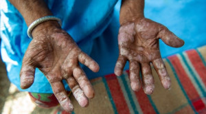 Lepra: Eliminasi, Vaksinasi, dan Kemoprofilaksis