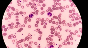 Neutropenia Akibat Penggunaan Antipsikotik Clozapine
