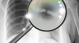 Inovasi Pengawasan Pemulihan Fraktur Iga Lewat Spirometri Jarak Jauh dan Aplikasi Ponsel – Telaah Jurnal Alomedika