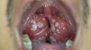 Tata Laksana Perdarahan Pasca Tonsilektomi