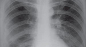 Ciri Pasien PPOK yang Membutuhkan Bulektomi