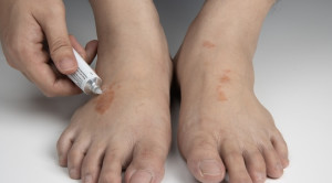 Stop Penggunaan Kortikosteroid untuk Tinea