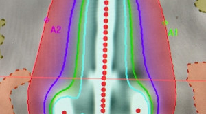 Peran Brakhiterapi pada Kanker Serviks