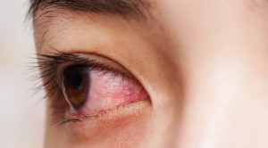 Efikasi Implan Kortikosteroid untuk Uveitis Kronis Non-Infeksi