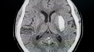 Pilihan Pemeriksaan Radiologi untuk Stroke Hemoragik