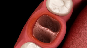 Terapi Topikal pada Osteitis Alveolar atau Dry Socket