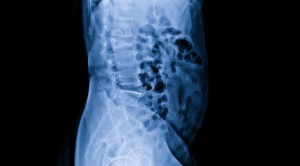 Vertebroplasty untuk Osteoporosis