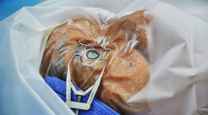 Keuntungan dan Risiko Operasi Katarak Simultan Bilateral