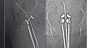 Efikasi Brakhiterapi pada Keganasan Endometrium