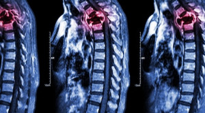 Peran Radiasi pada Kasus Metastasis ke Vertebrae