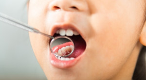 Silver Diamine Fluoride Tidak Efektif Mencegah Karies