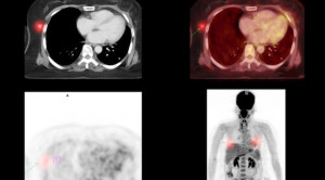 Peran Pemeriksaan Kedokteran Nuklir dalam Penyakit Tuberkulosis