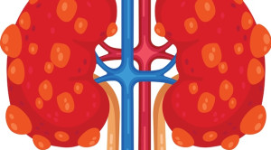 Efek Dapaglifozin pada Pasien Penyakit Ginjal Polikistik yang Mendapat Tolvaptan – Telaah Jurnal Alomedika