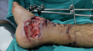 Panduan Profilaksis Antibiotik pada Pasien Trauma