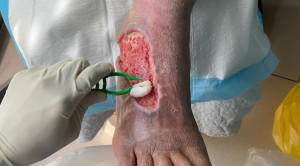 Efektivitas Povidone Iodine dalam Tata Laksana Luka Kronis